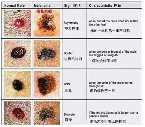 側腰上有痣|【側腰有痣】揭曉側腰有痣的驚人秘密：財運、桃花、家世大不。